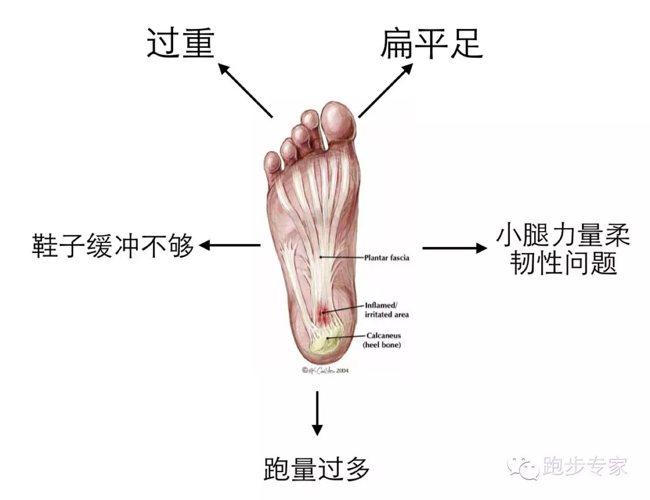 体重过重、跑量过多、扁平足、跑鞋不适、下肢柔软度不佳等