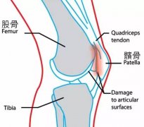 关于运动爱好者的一个问题—髌骨软化症