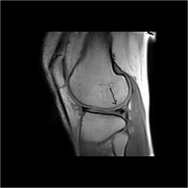 (图片4)半月板内Ⅲ级信号，后角内稍高信号达及关节面未及关节囊